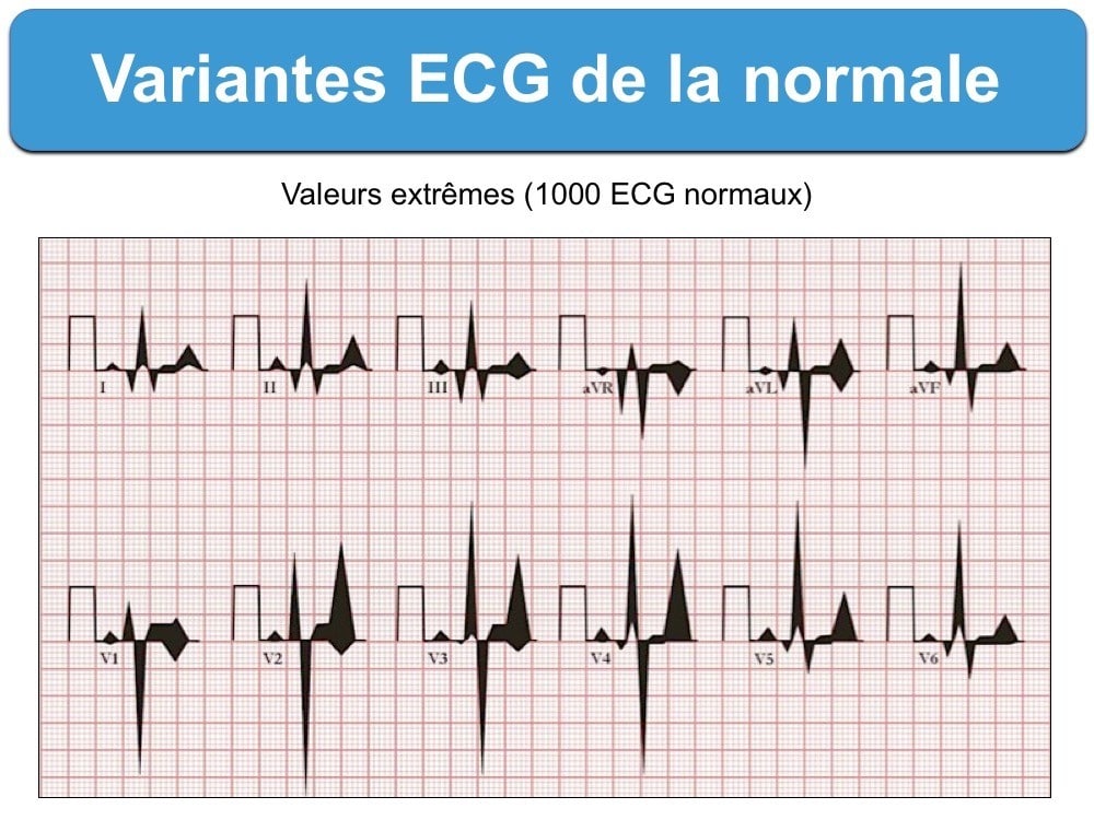 variantes ecg de la normale
